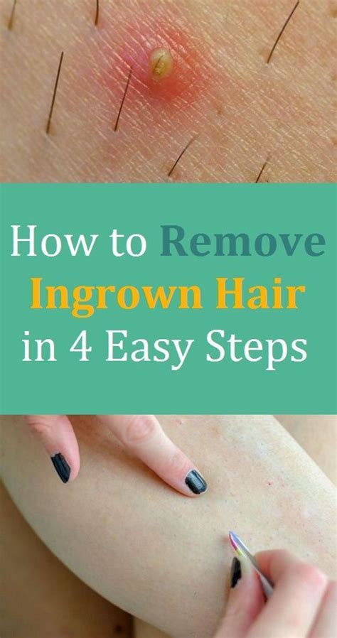 Rinse it off thoroughly using lukewarm water. How to Remove Ingrown Hair in 4 Easy Steps | Ingrown hair ...