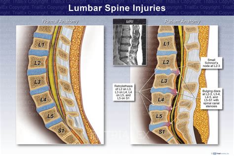 Lumbar Spine Injuries Trial Exhibits Inc