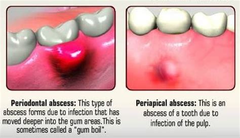 Dental Abscess Symptoms Causes Treatment Pictures