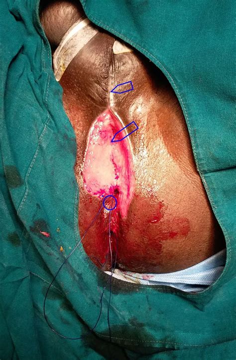 Long Anterior Anal Fistula With An External Opening In The Medial Raphe