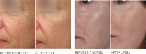 Nano Laser Peel Q Skin Clinic Brisbane North Bulk