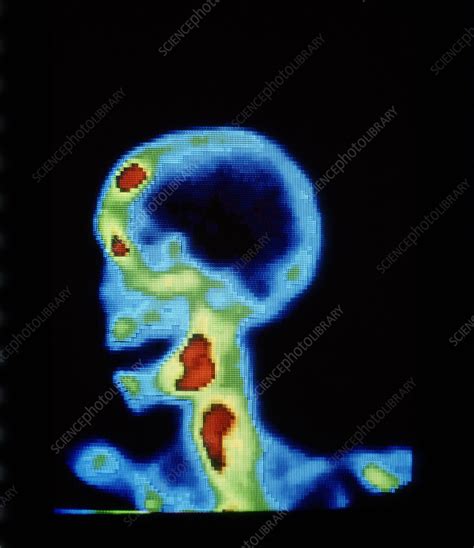 Gamma Camera Scan Of Skull Of Cancer Patient Stock Image M1340057