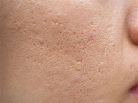 10 Acne Scar Treatments Recommended By The Dermatologist