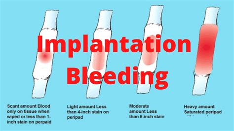 What Does Heavy Implantation Bleeding Look Like