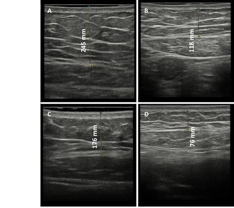 Ultrasound Imaging Of A Year Old Woman Who Underwent Four Sessions Download Scientific