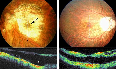 Development Of Macular Hole And Macular Retinoschisis In Eyes With
