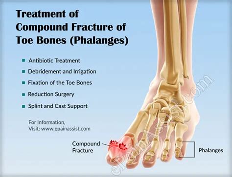 Compound Fracture Of Toe Bones Phalangescausessymptomstreatment