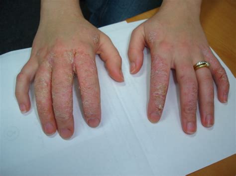 Dermatitis As Related To Latex Allergy Pictures