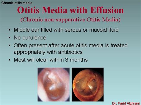 Chronic Otitis Media Dr Farid Alzhrani Assistant Professor