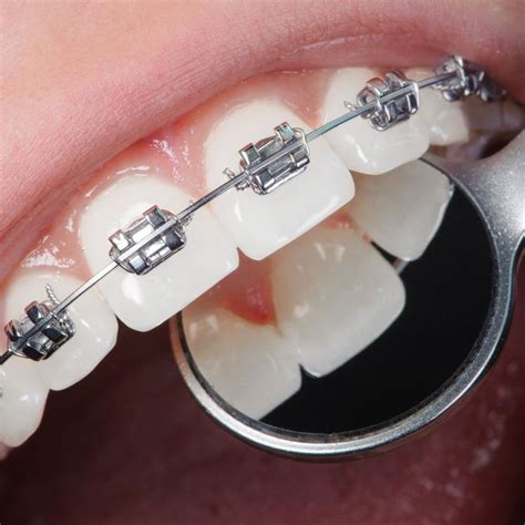 Orthodontic Emergencies What To Do If You Break Your Braces John S