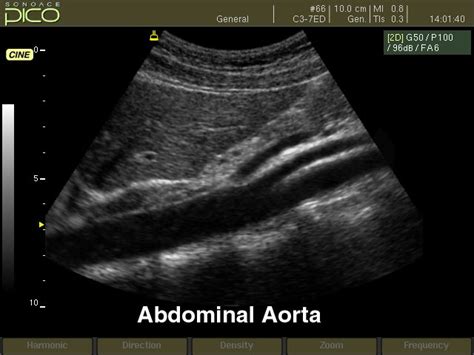 Ultrasound Images • Abdominal Aorta B Mode Echogramm №239