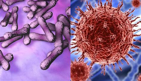 Existen dos tipos de difteria. Coronavirus: EsSalud indica que la difteria es peor que la ...