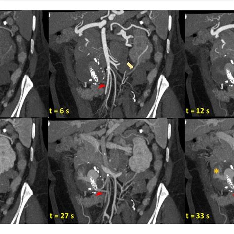 Time Resolved Coronal D CTA Images Illustrating The Flow From The SMA