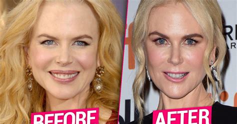 Nicole Kidmans Plastic Surgery Transformation Top Docs Claim Facelift Fillers To Blame