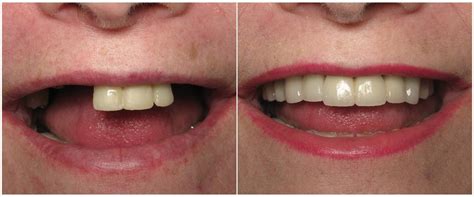 New Set Of Teeth In A Day All On 4 Dental Implants