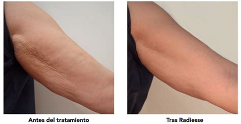 Check spelling or type a new query. ¡BRAZOS ARRIBA! - Clinica Acido Hialuronico Madrid