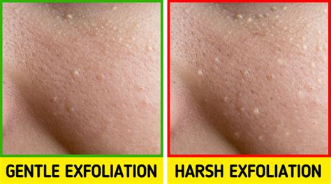 What Those Little White Bumps On Your Skin Are And What To Do About