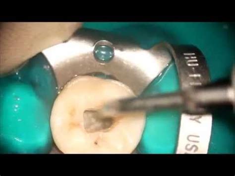 Second Mandibular Molar Endodontic Acces Cavity YouTube