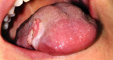 Tongue Cancer In Young Patients Case Report Of A 26 Year Old Patient