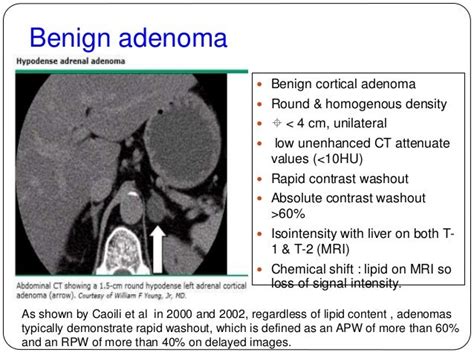 Imaging Of Adrenal Masses