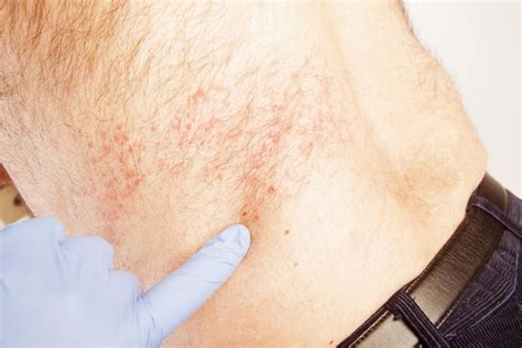 Itchy Skin Rash Pictures Causes Symptoms Treatment