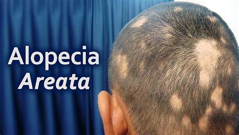 Alopecia Areata Types Causes And Treatments