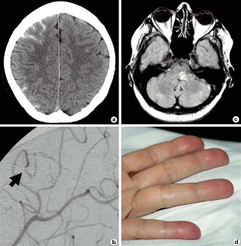 Figure 1 From Subarachnoid Hemorrhage And Diplopia As Initial
