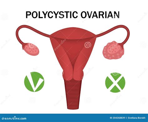 Polycystic Ovary Disease And A Healthy Ovary Medical Infographics