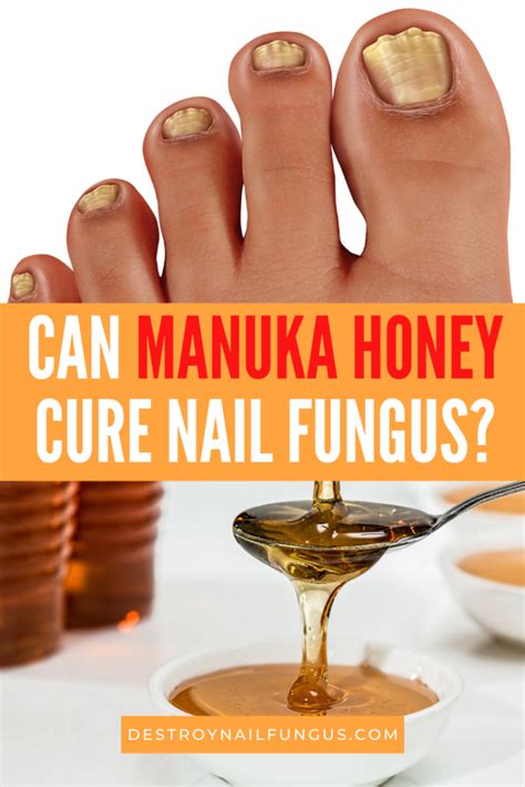 Manuka Honey For Nail Fungus Everything You Need To Know Destroy
