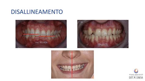 Studio Dentistico Caneva Disallineamento Dei Denti Malocclusioni