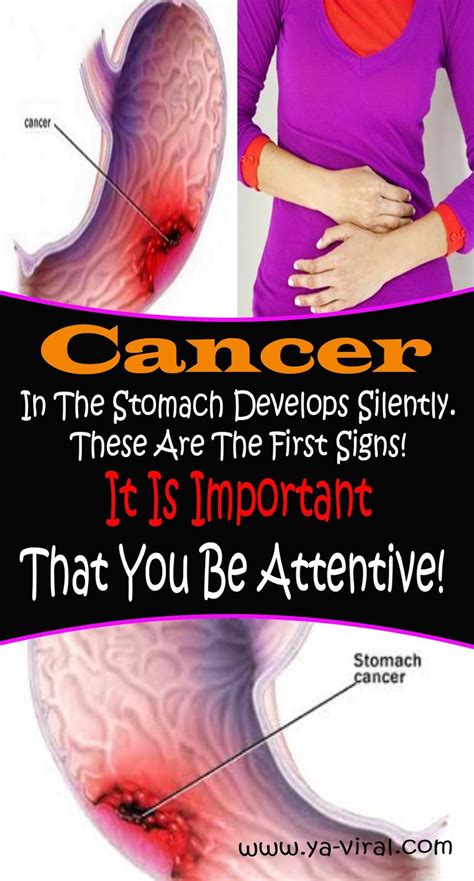Cancer In The Stomach Develops Silently These Are The First Signs It