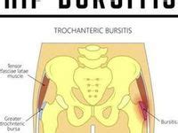 Bursitis Ideas In Bursitis Bursitis Hip Best Exercise For Hips