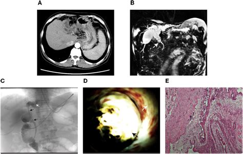 A Enhanced Ct Showed The Dilation Of Intrahepatic Bile Duct B Mrcp