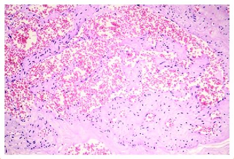 Histopathological Section Of A Capillary Hemangioma With Endothelial