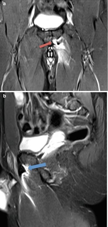 Adductor Muscles Injuries Musculoskeletal Key