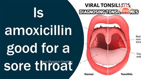 Is Amoxicillin Good For A Sore Throat English Health Tips Youtube
