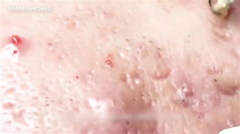 Remove Big Acne Pimples Blackhead Popping Blackhead Popping Video