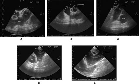 Subacute Massive Pulmonary Embolism Diagnosed By Transesophageal Echocardiography Circulation