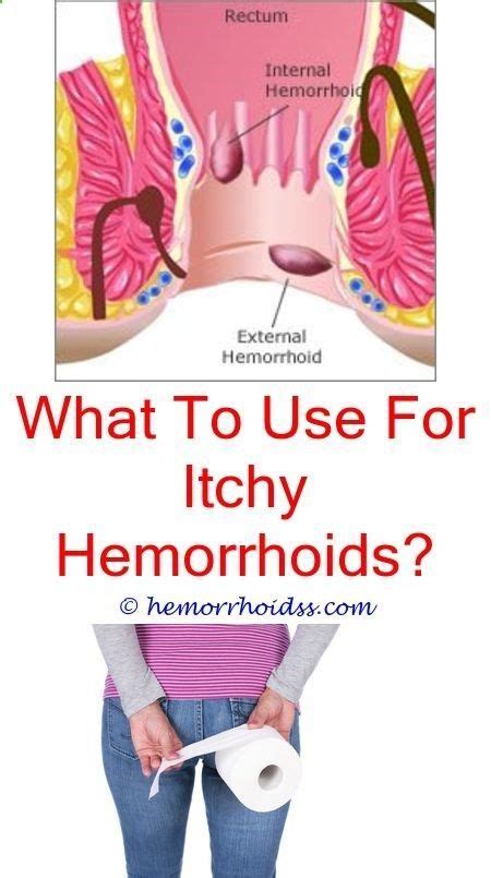 What You Should Know About Your Hemorrhoids Hemorrhoids Treatment