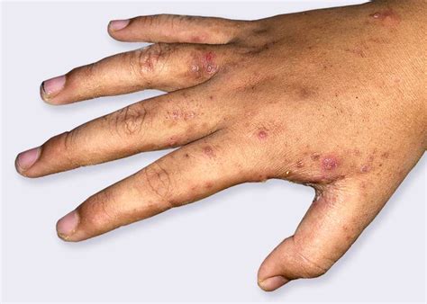 Scabies Rash On Hand The Best Porn Website