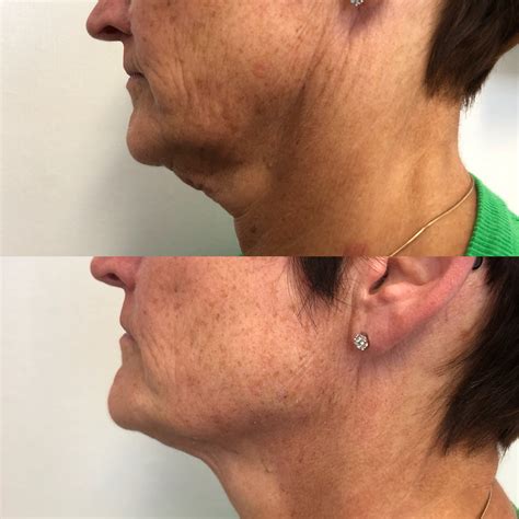 Jawline And Neck Tightening Greenwood Dental And Facial Aesthetic Clinic