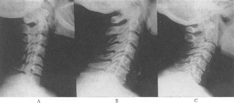 Spinal Osteoarthritis