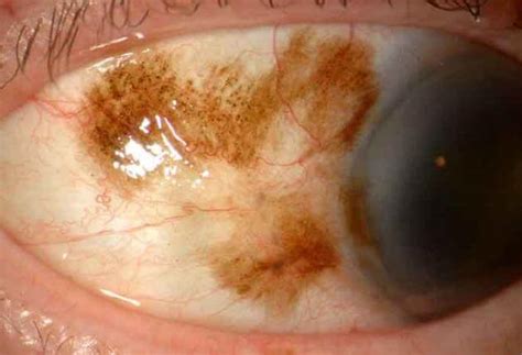 Cornea And External Disease