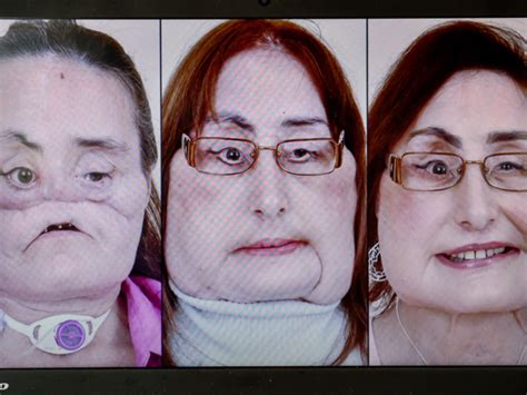 ‘full Facial Transplants A Near Possibility In Uae Society Gulf News