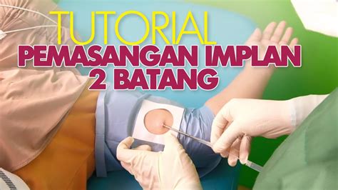 TUTORIAL PEMASANGAN IMPLAN BATANG YouTube