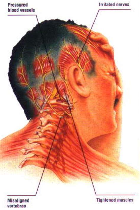 Can Neck And Spine Misalignment Cause Migraines Youmemindbody
