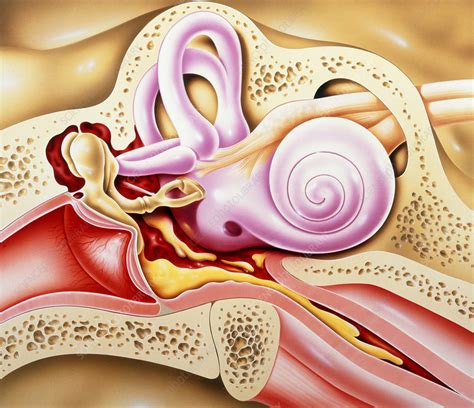Otitis Media Of Ear Stock Image M1570029 Science Photo Library