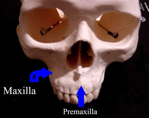 Oral And Maxillo Facial Surgery Maxillary Fractures In Children
