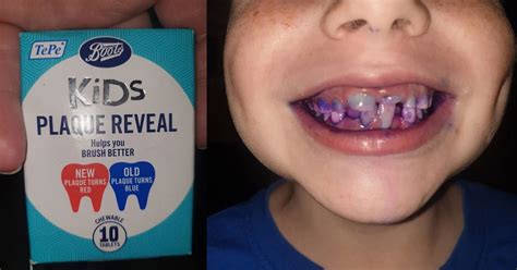 A Mom Shared How Chewable Dental Tablets Helped Her To See If Her Son