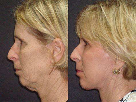 Facelift Tampa 100 5 Star Reviews Elite Facial Plastic Surgery